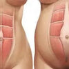 The Mummy Tummy – Diastasis Recti