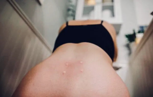 Sterile Water Injections – Labour Pain Relief